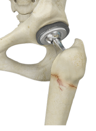 Periprosthetic Hip Infection