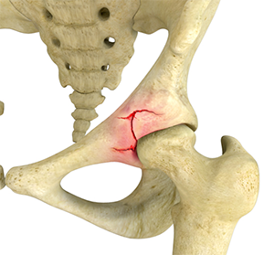 Acetabular Fracture