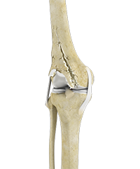 Complex Total Knee Replacement