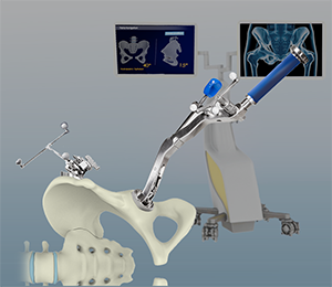 Computer-Navigated Total Hip Replacement