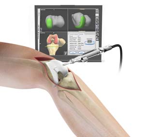 Computer Navigation for Total Knee Replacement