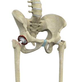 Correction of a Failed Hip Replacement