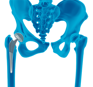 Correction of a Loose Hip Replacement