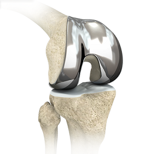 Custom-fitted Total Knee Arthroplasty