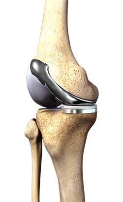 Custom Knee Replacement