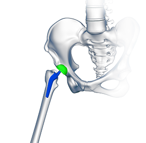 Custom/Patient-Specific Hip Replacement