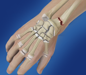 Distal Radius Fractures