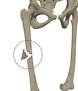 Femoral Shaft Fracture