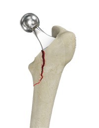 Femur Fracture