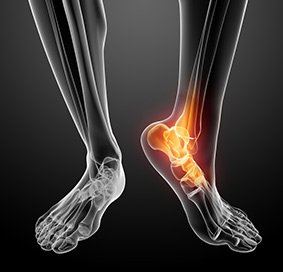 Calcaneus Fracture