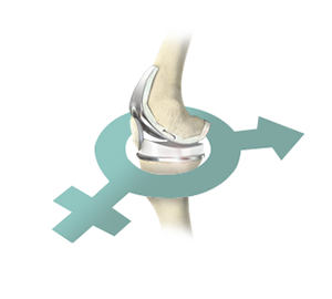 Gender-Specific Knee Replacement