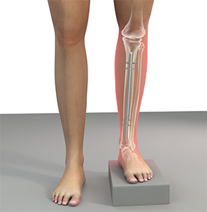 Leg Length Discrepancy Jersey City | Limb Lengthening Surgery Livingston, Essex County, NJ, NY, CT
