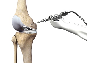 Mako SmartRobotics for Partial Knee Replacement