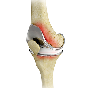 Painful or Failed Total Knee Replacement
