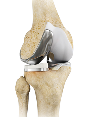 Partial Lateral Knee Replacement