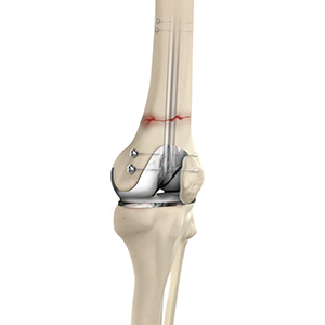 Periprosthetic Knee Fracture Fixation