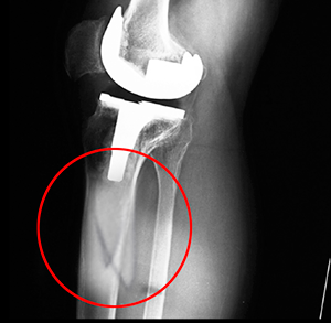 Periprosthetic Knee Fractures