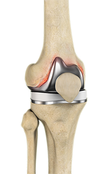 Periprosthetic Knee Infection