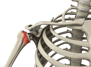 Periprosthetic Shoulder Fracture