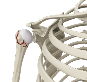 Proximal Humerus Fractures