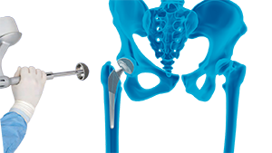 Robotic Total Hip Replacement