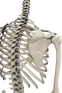 Fracture of the Shoulder Blade (Scapula)