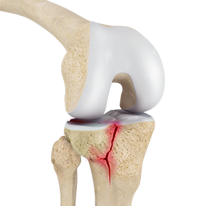 Tibial Plateau Fracture