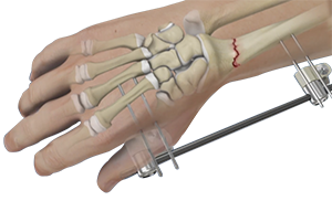 Wrist Fracture Fixation